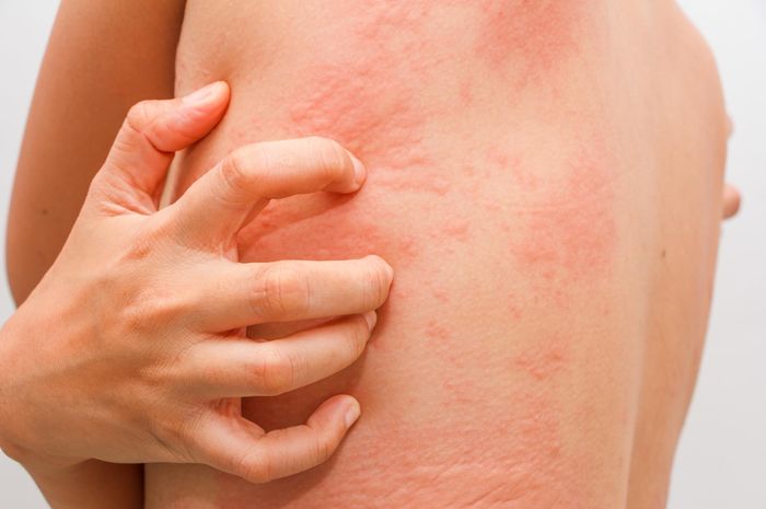 ciri ciri orang yang mempunyai tubuh alergi ini lah penyebabnya .